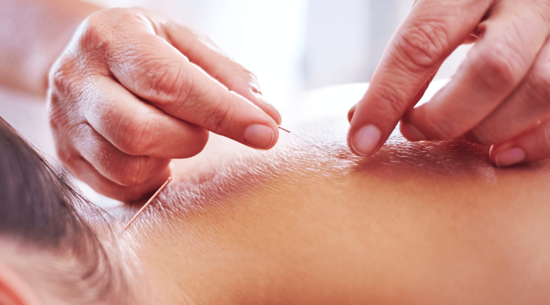 An image of a person's hands inserting acupuncture needles into someone's back.